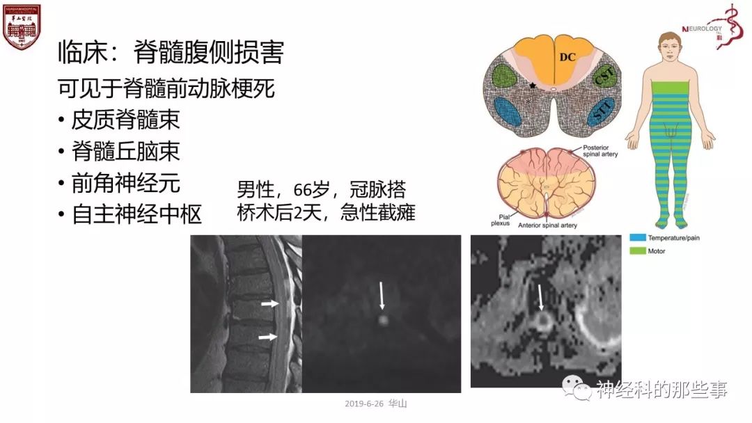 香港脊髓研究获重大突破，开启治疗新纪元